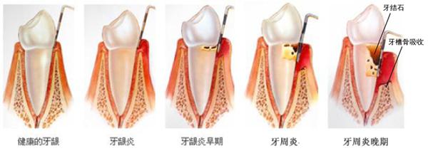 怎么治療牙齦炎？