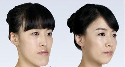 35歲地包天矯正牙齒有效果嗎？