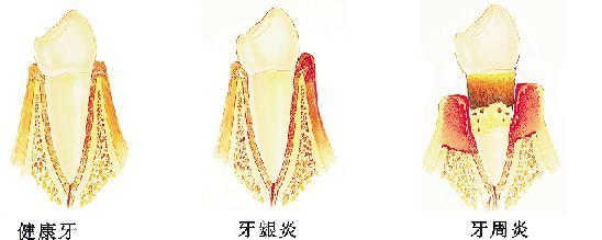 孕期牙齦炎怎么治療？