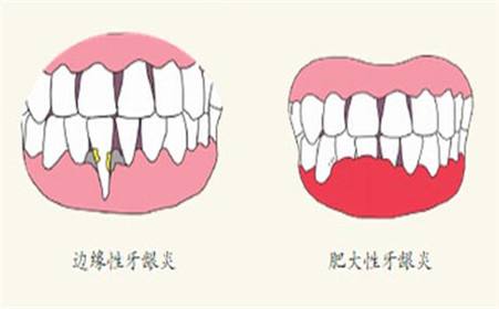 孕期牙齦炎怎么治療？